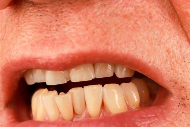 Adam iki ön dişindeki küçük çipleri gösteriyor.