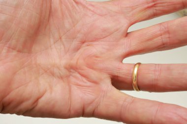 Avucunda Dupuytren Sözleşmesi olan kıdemli bir adam.