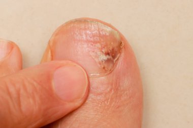 Yaralı ve enfekte olmuş ayak parmağı olan bir adam. 