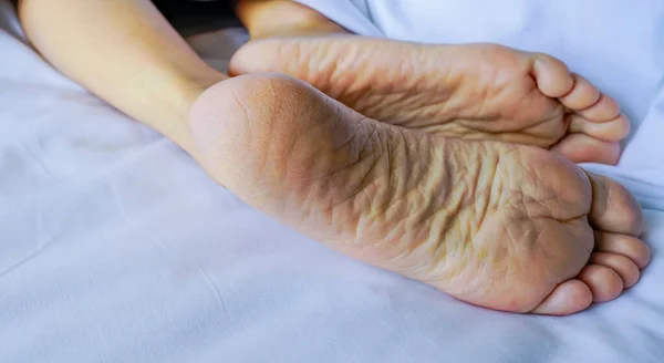 Close-up cracked heel. Dry foot care needs skincare for foot. Women sleep barefoot on a white comfort bed in hotel or home bedroom. Lazy Sunday morning. Cracked heel needs foot spa and pedicure.