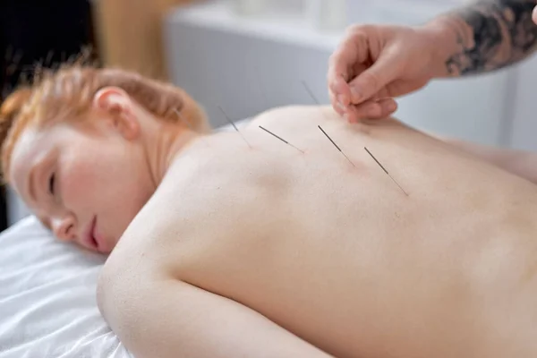 hand of professional doctor performing acupuncture therapy for female redhead client. woman undergoing acupuncture treatment with a line of fine needles inserted into the her body skin in clinic