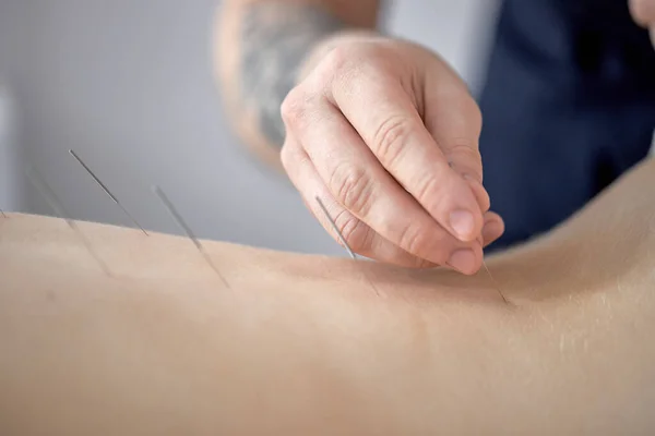 Acupuncture in back of female, unrecognizable male massagist making osteoarthritis treatment in spine back for rehabilitation in clinic hospital. close-up focus on female body. healthy lifestyle