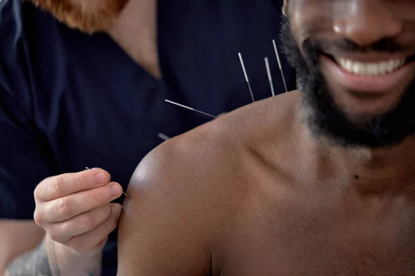 acupuncture therapy on back spine shoulders for black male client. cropped man undergoing acupuncture treatment with a line of fine needles inserted into body skin in clinic hospital, close-up
