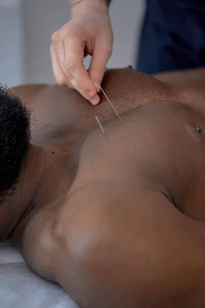 unrecognizable professional doctor performing acupuncture therapy on chest for black male client. close-up.man undergoing acupuncture treatment with a line of needles inserted into body skin