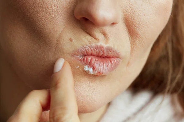 Closeup Middle Aged Woman Herpes Lips Applying Ointment Using Finger — Stock Photo, Image