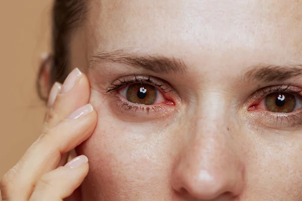Close Jovem Mulher Com Olhos Inflamados — Fotografia de Stock