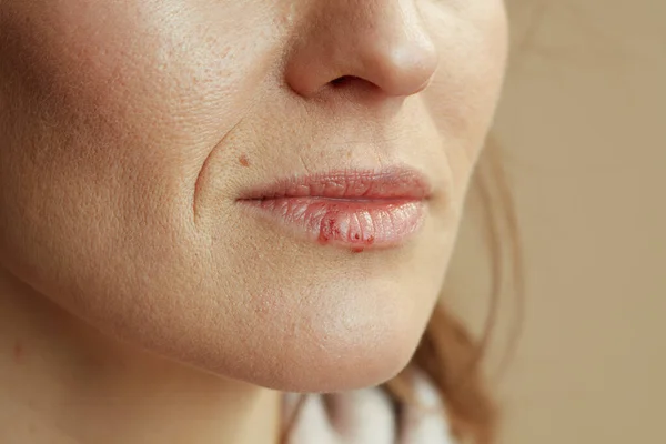 Zbliżenie Kobiety Opryszczką Ustach Beżowym Tle — Zdjęcie stockowe