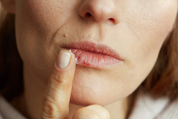 唇にヘルペスを持つ女性の上の閉鎖はベージュの背景に指を使用して軟膏を適用 — ストック写真