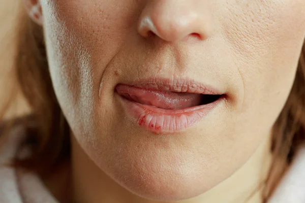 Κοντινό Πλάνο Γυναίκα Έρπη Γλείφει Χείλη Μπεζ Φόντο — Φωτογραφία Αρχείου