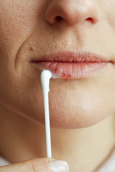 Zbliżenie Kobietę Opryszczką Ustach Stosującą Maść Użyciem Wacika Beżowym Tle — Zdjęcie stockowe