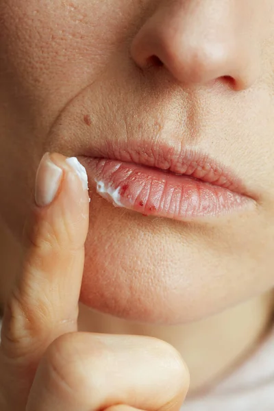 閉じる上の40歳の女性とともにヘルペスオン唇に軟膏を適用指でベージュの背景 — ストック写真