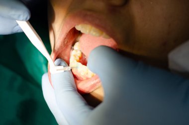 Diş hekimi diş aletlerini kullanarak seramik parantezlerle dişleri kontrol ediyor