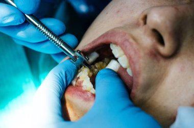 Diş hekimi diş aletlerini kullanarak seramik parantezlerle dişleri kontrol ediyor