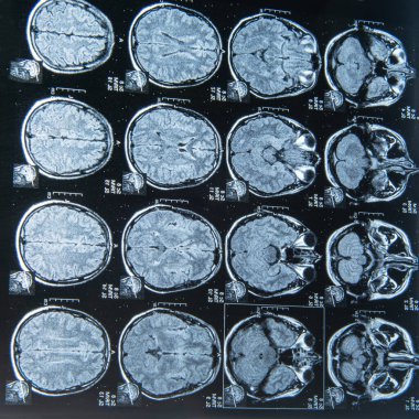 Tanı için beyin MRI tarama görüntü