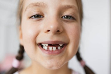 Dişleri döküldüğü için dökülmüş beyaz bir kızın portresi. Saçı örgülü, çocukluk masumiyeti ve neşesiyle mutlu bir şekilde gülümsüyor, ev ortamında yakalanmış..