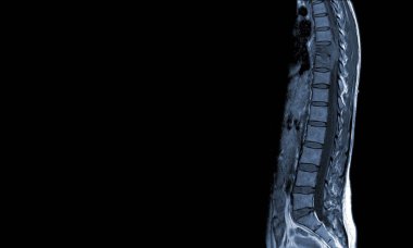 Torasik omurga MR 'ı T9 omurunda orta dereceli patolojik basınç kırığı ve paravertebral apse T9-10..