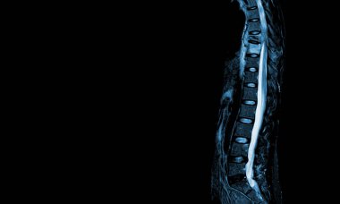 Torasik omurga MR 'ı T9 omurunda orta dereceli patolojik basınç kırığı ve paravertebral apse T9-10..