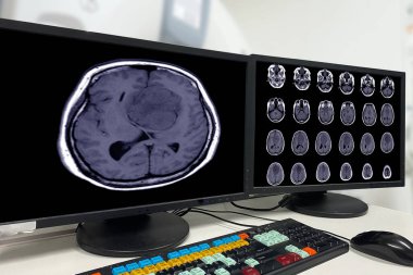 Anterior falx serebri 'den kaynaklanan menenjiyomun MRI BRAIN bulgusu, çift taraflı frontal bölgelere kadar uzanıyor, sol frontal lobda bitişik asgari tehlike ödemi, tıbbi görüntü kavramı.