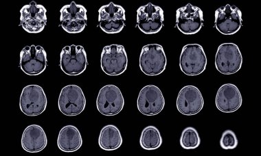 Anterior falx serebri 'den kaynaklanan menenjiyomun MRI BRAIN bulgusu, çift taraflı frontal bölgelere kadar uzanıyor, sol frontal lobda bitişik asgari tehlike ödemi, tıbbi görüntü kavramı.