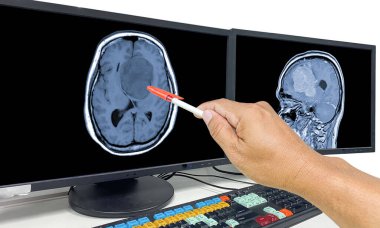 Glioblastoma, beyin metastazı, MRI Beyin Doktoru, bilgisayar ekranındaki beyin tümörünün yerini gösterdi.