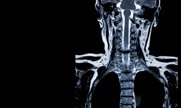 Mri Tesla Cervical Spine Performed Axial T2W Moderate Spinal Cord — Stock Photo, Image