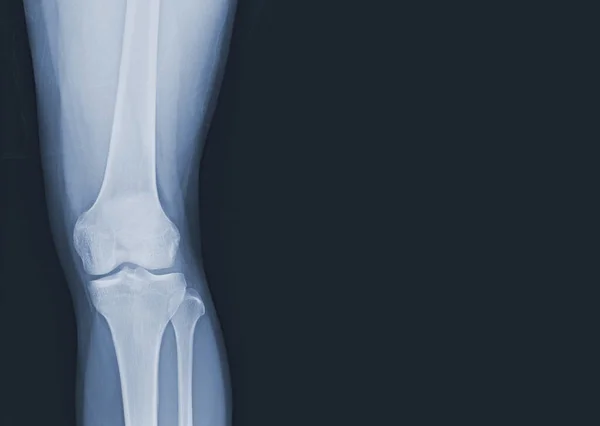 人間の膝関節と靭帯のフィルムX線医療画像の概念 — ストック写真