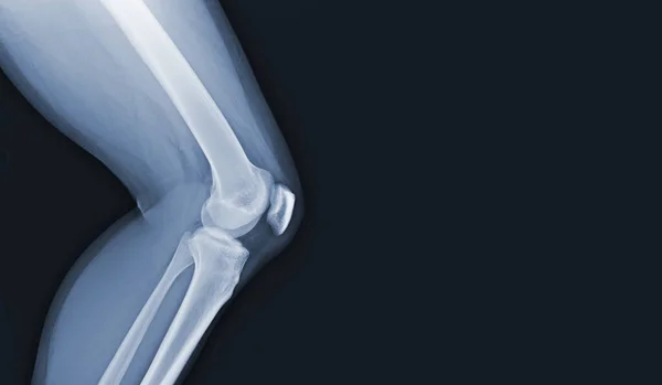 人間の膝関節と靭帯のフィルムX線医療画像の概念 — ストック写真