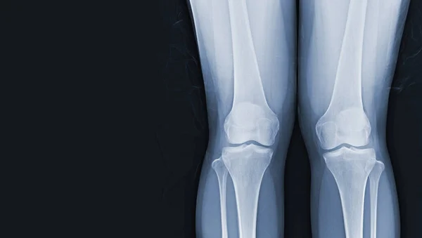 Film Ray Manusia Baik Lutut Berdiri Melihat Sendi Normal Dan — Stok Foto