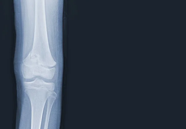 人体膝部X线片显示闭合性骨折 股骨右侧远端 正常关节及韧带 — 图库照片