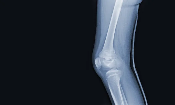 Radiografia Joelho Humano Mostrando Fratura Fechada Fêmur Distal Direito Articulações — Fotografia de Stock