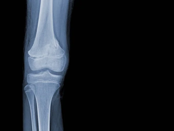 Film Ray Human Knee Showing Closed Fracture Right Distal Femur — Stock Photo, Image