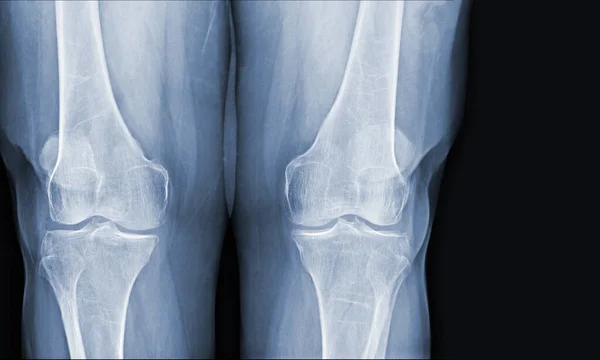 Radiografía Película Las Articulaciones Ligamentos Normales Rodilla Humana Concepto Imagen — Foto de Stock
