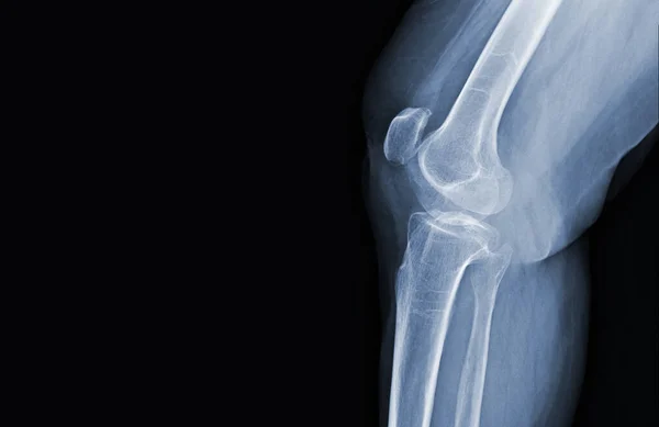 Radiografía Película Las Articulaciones Ligamentos Normales Rodilla Humana Concepto Imagen —  Fotos de Stock