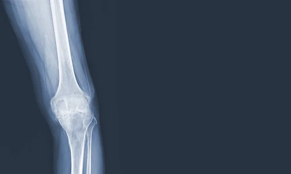 Рентгенівський Знімок Коліна Людини Важкий Остеоартрит Нормальних Язок Коліна Концепція — стокове фото