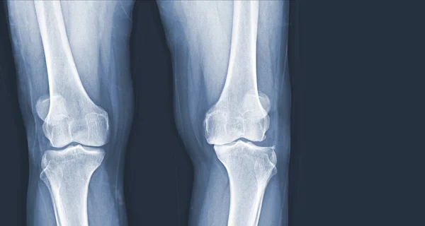 Radiografía Película Rodilla Humana Osteoartritis Rodilla Ligamentos Normales Concepto Imagen —  Fotos de Stock