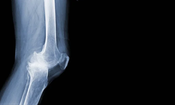 Film Röntgen Emberi Térd Súlyos Osteoarthritis Térd Normális Szalagok Orvosi — Stock Fotó