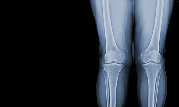 Radiografia Filme Humanos Ambos Joelho Visualizações Articulações Normais Ligamentos Conceito — Fotografia de Stock