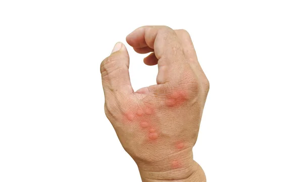 特写蜜蜂 刺痛的手昆虫对工人皮肤过敏 蜜蜂过敏 野生生物 野生生物 医学图像概念 — 图库照片