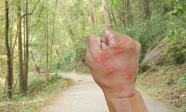 Close Mão Abelha Picada Mão Insetos Trabalhador Pele Alergia Tratamento — Fotografia de Stock