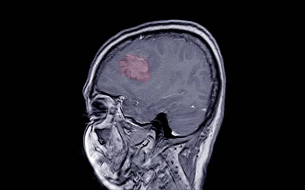 Rmn Cerebro Hallazgo Meningioma Derivado Del Falx Cerebral Anterior Extendiéndose —  Fotos de Stock
