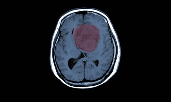 Anterior Falx Serebri Den Kaynaklanan Menenjiyomun Mri Brain Bulgusu Çift — Stok fotoğraf