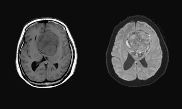 Mri脳前頭前頭葉から発生する髄膜腫の発見 二国間前頭葉にまたがります 左前頭葉に隣接する最小限の視神経浮腫を有します 医療画像の概念 — ストック写真