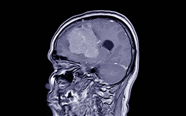 Мрт Brain Пошук Менінгоми Виникають Переднього Мозочка Простягається Двосторонніх Лобових — стокове фото