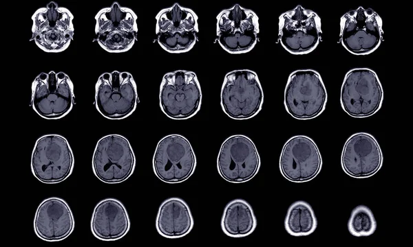 Mri脳前頭前頭葉から発生する髄膜腫の発見 二国間前頭葉にまたがります 左前頭葉に隣接する最小限の視神経浮腫を有します 医療画像の概念 — ストック写真
