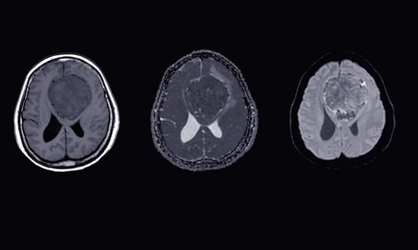 Mri Brain Finding Meningioma Arising Anterior Falx Cerebri Extending Bilateral — Stock Photo, Image