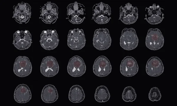 Mri Brain Nalezení Meningiomu Vzniklého Přední Falx Cerebri Rozšiřující Bilaterálních — Stock fotografie