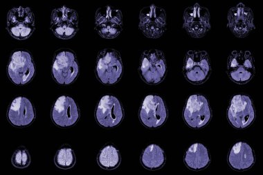 Beyin tümörünü değerlendirmek için MRI Eksen Görüntüleri. Glioblastoma, beyin metastazı izoyoğunluk kütlesi. Belirsiz bir marj ve sağ ön lobunda ödem var..