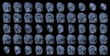 Beyin tümörünü değerlendirmek için MRI Eksen Görüntüleri. Glioblastoma, beyin metastazı izoyoğunluk kütlesi. Belirsiz bir marj ve sağ ön lobunda ödem var..