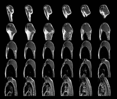 Omuz tümörünün manyetik rezonans görüntülemesi veya kitlesel bilim ve eğitim MRI omuz arka planı