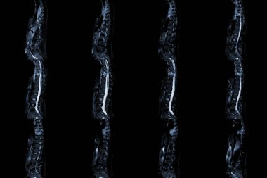 Torasik omurga sagital MRI geçmişinde sırt ağrısı ve T9 tıp ve eğitim konseptinde sıkışma kırığı var..